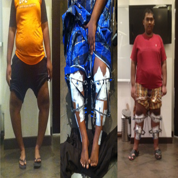 عظام البالغين