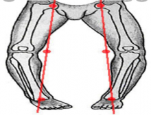 تصحيح تشوهات العظام للبالغين 